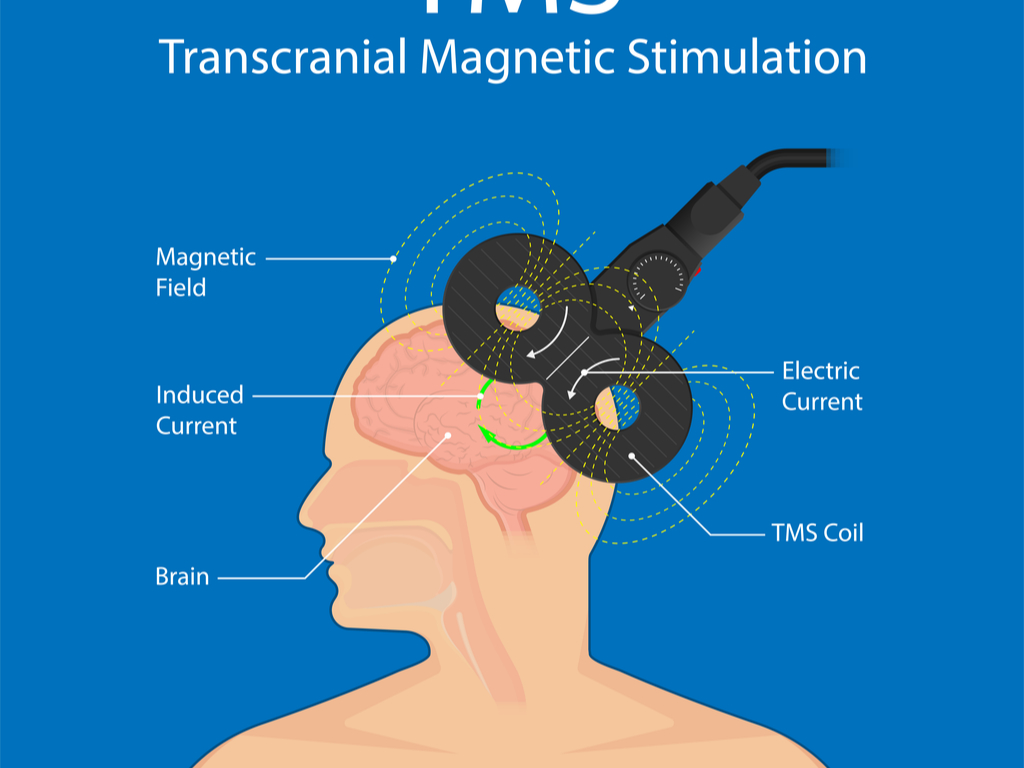 About Transcranial Stimulation, Tampa FL